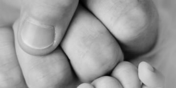 Shining a Light on Newborn Jaundice: Recognizing the Signs and Symptoms